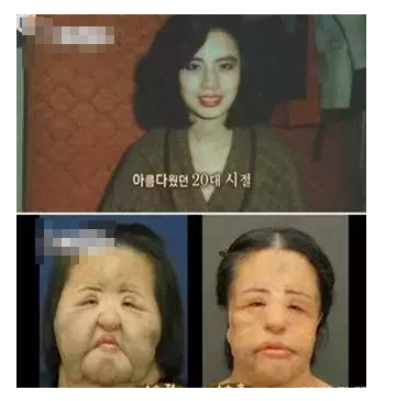 整容發(fā)生意外保險(xiǎn)賠嗎？